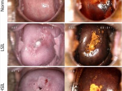 Δες φωτογραφίες από hpv